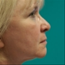 Facelift Before Photo by Brian Buinewicz, MD; Doylestown, PA - Case 25212