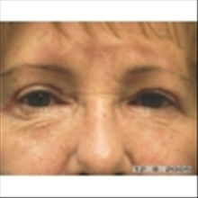 Eyelid Surgery After Photo by Brian Buinewicz, MD; Doylestown, PA - Case 25213