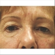 Eyelid Surgery Before Photo by Brian Buinewicz, MD; Doylestown, PA - Case 25213