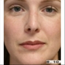 Rhinoplasty After Photo by Brian Buinewicz, MD; Doylestown, PA - Case 25214