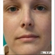Rhinoplasty Before Photo by Brian Buinewicz, MD; Doylestown, PA - Case 25214