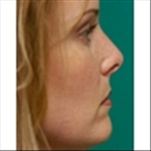 Rhinoplasty After Photo by Brian Buinewicz, MD; Doylestown, PA - Case 25214