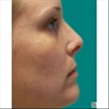 Rhinoplasty Before Photo by Brian Buinewicz, MD; Doylestown, PA - Case 25214