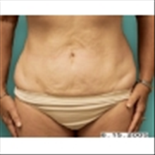 Liposuction After Photo by Brian Buinewicz, MD; Doylestown, PA - Case 25215
