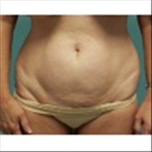Liposuction Before Photo by Brian Buinewicz, MD; Doylestown, PA - Case 25215