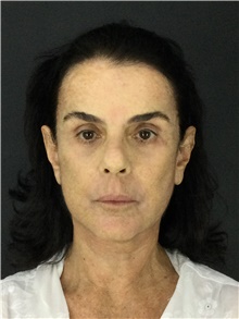 Facelift After Photo by Marcelo Daher, MD; Rio de Janeiro, RJ - Case 48898