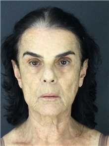 Facelift Before Photo by Marcelo Daher, MD; Rio de Janeiro, RJ - Case 48898