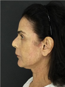 Facelift After Photo by Marcelo Daher, MD; Rio de Janeiro, RJ - Case 48898