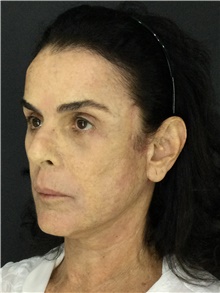 Facelift After Photo by Marcelo Daher, MD; Rio de Janeiro, RJ - Case 48898