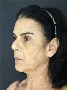 Facelift Before Photo by Marcelo Daher, MD; Rio de Janeiro, RJ - Case 48898