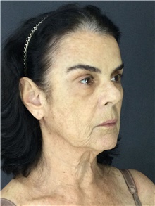 Facelift Before Photo by Marcelo Daher, MD; Rio de Janeiro, RJ - Case 48898