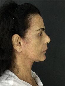 Facelift After Photo by Marcelo Daher, MD; Rio de Janeiro, RJ - Case 48898