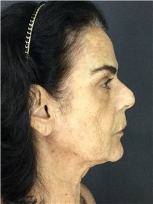 Facelift Before Photo by Marcelo Daher, MD; Rio de Janeiro, RJ - Case 48898