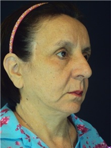 Facelift After Photo by Marcelo Daher, MD; Rio de Janeiro, RJ - Case 48900