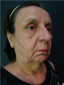 Facelift Before Photo by Marcelo Daher, MD; Rio de Janeiro, RJ - Case 48900