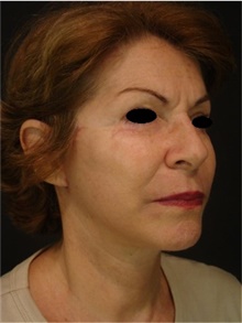 Facelift After Photo by Marcelo Daher, MD; Rio de Janeiro, RJ - Case 48901