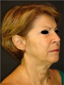 Facelift Before Photo by Marcelo Daher, MD; Rio de Janeiro, RJ - Case 48901