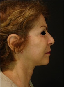 Facelift After Photo by Marcelo Daher, MD; Rio de Janeiro, RJ - Case 48901