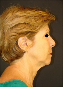 Facelift Before Photo by Marcelo Daher, MD; Rio de Janeiro, RJ - Case 48901