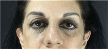 Eyelid Surgery After Photo by Marcelo Daher, MD; Rio de Janeiro, RJ - Case 49137