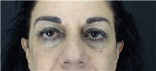 Eyelid Surgery Before Photo by Marcelo Daher, MD; Rio de Janeiro, RJ - Case 49137