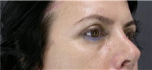 Eyelid Surgery After Photo by Marcelo Daher, MD; Rio de Janeiro, RJ - Case 49138