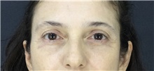 Eyelid Surgery After Photo by Marcelo Daher, MD; Rio de Janeiro, RJ - Case 49140