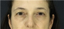 Eyelid Surgery Before Photo by Marcelo Daher, MD; Rio de Janeiro, RJ - Case 49140