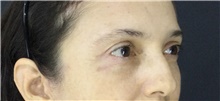 Eyelid Surgery After Photo by Marcelo Daher, MD; Rio de Janeiro, RJ - Case 49140