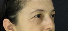 Eyelid Surgery Before Photo by Marcelo Daher, MD; Rio de Janeiro, RJ - Case 49140