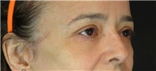 Eyelid Surgery After Photo by Marcelo Daher, MD; Rio de Janeiro, RJ - Case 49141