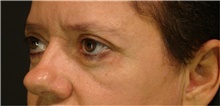 Eyelid Surgery After Photo by Marcelo Daher, MD; Rio de Janeiro, RJ - Case 49142