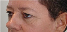 Eyelid Surgery Before Photo by Marcelo Daher, MD; Rio de Janeiro, RJ - Case 49142