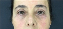 Eyelid Surgery After Photo by Marcelo Daher, MD; Rio de Janeiro, RJ - Case 49143