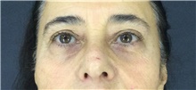 Eyelid Surgery Before Photo by Marcelo Daher, MD; Rio de Janeiro, RJ - Case 49143