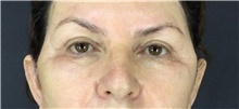 Eyelid Surgery After Photo by Marcelo Daher, MD; Rio de Janeiro, RJ - Case 49144