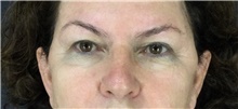 Eyelid Surgery Before Photo by Marcelo Daher, MD; Rio de Janeiro, RJ - Case 49144