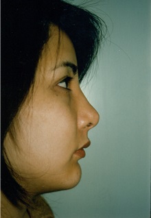 Rhinoplasty After Photo by Jon Harrell, DO, FACS; Weston, FL - Case 24185