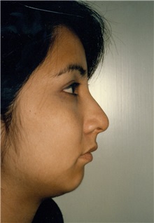 Rhinoplasty Before Photo by Jon Harrell, DO, FACS; Weston, FL - Case 24185