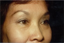 Eyelid Surgery After Photo by Jon Harrell, DO, FACS; Weston, FL - Case 24187