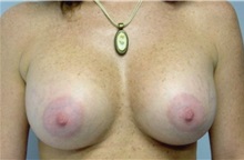 Breast Augmentation After Photo by Jon Harrell, DO, FACS; Weston, FL - Case 24189