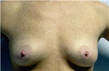 Breast Augmentation Before Photo by Jon Harrell, DO, FACS; Weston, FL - Case 24189