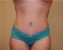 Tummy Tuck After Photo by Jon Harrell, DO, FACS; Weston, FL - Case 24190