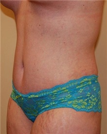 Tummy Tuck After Photo by Jon Harrell, DO, FACS; Weston, FL - Case 24190