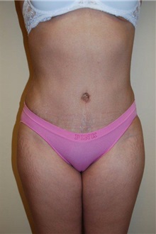 Tummy Tuck After Photo by Jon Harrell, DO, FACS; Weston, FL - Case 24191