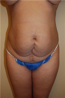 Tummy Tuck Before Photo by Jon Harrell, DO, FACS; Weston, FL - Case 24191