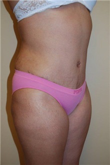 Tummy Tuck After Photo by Jon Harrell, DO, FACS; Weston, FL - Case 24191