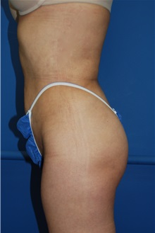Liposuction After Photo by Jon Harrell, DO, FACS; Weston, FL - Case 24192