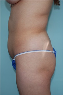 Liposuction Before Photo by Jon Harrell, DO, FACS; Weston, FL - Case 24192