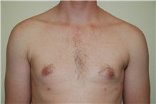 Male Breast Reduction After Photo by Jon Harrell, DO, FACS; Weston, FL - Case 24320